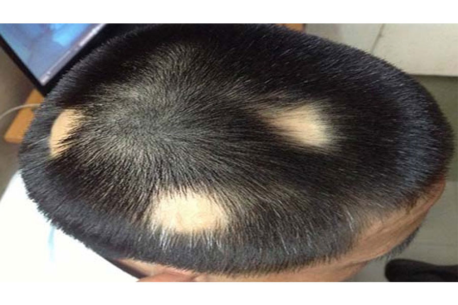 Alopecia Từng Mảng