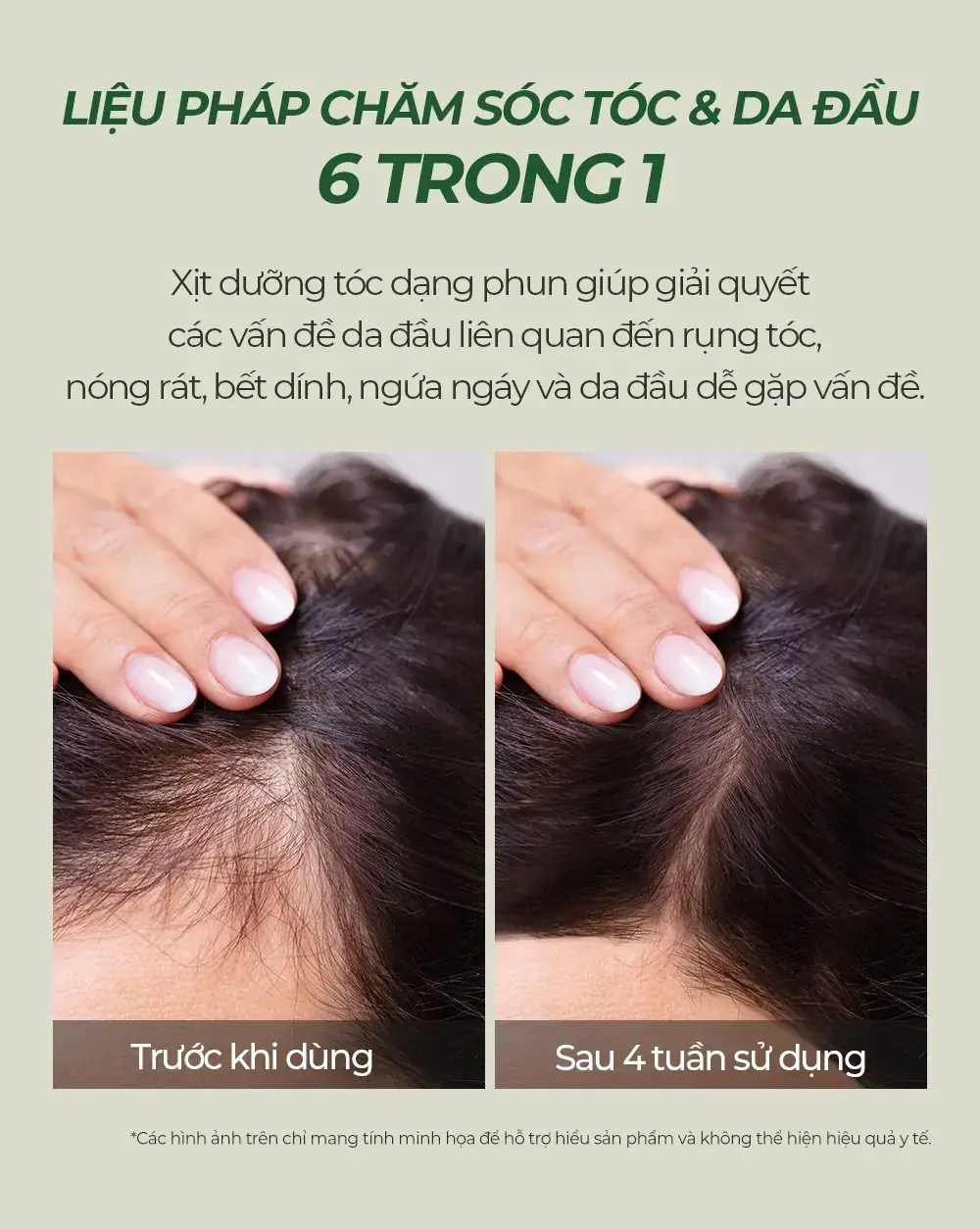 Da đầu trước khi dùng và sau 4 tuần dùng xịt dưỡng tóc Carenel High Intensity Anti Hair Loss Scalp Tonic, đường rẽ ngôi dày và đều hơn
